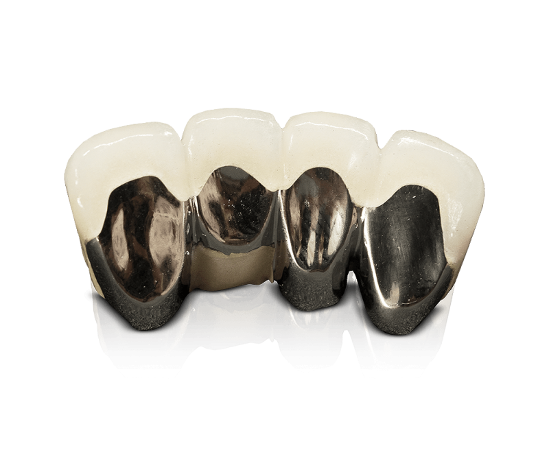 PFM Bridge – OB Dental Labs